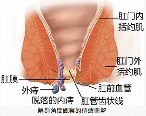 痔瘡示意圖