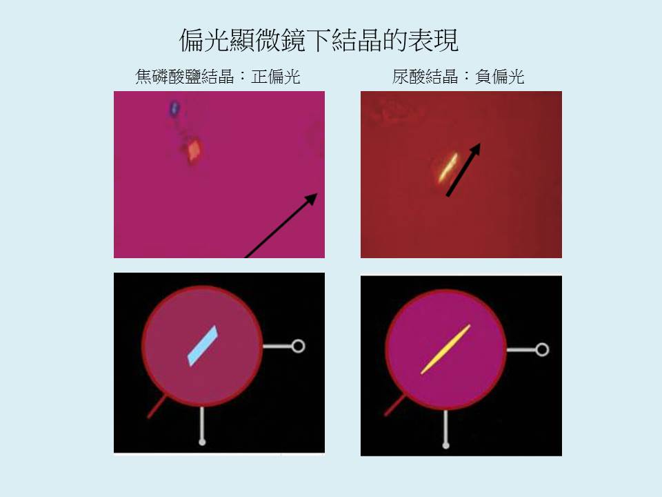 偏光顯微鏡於痛風診斷的重要性