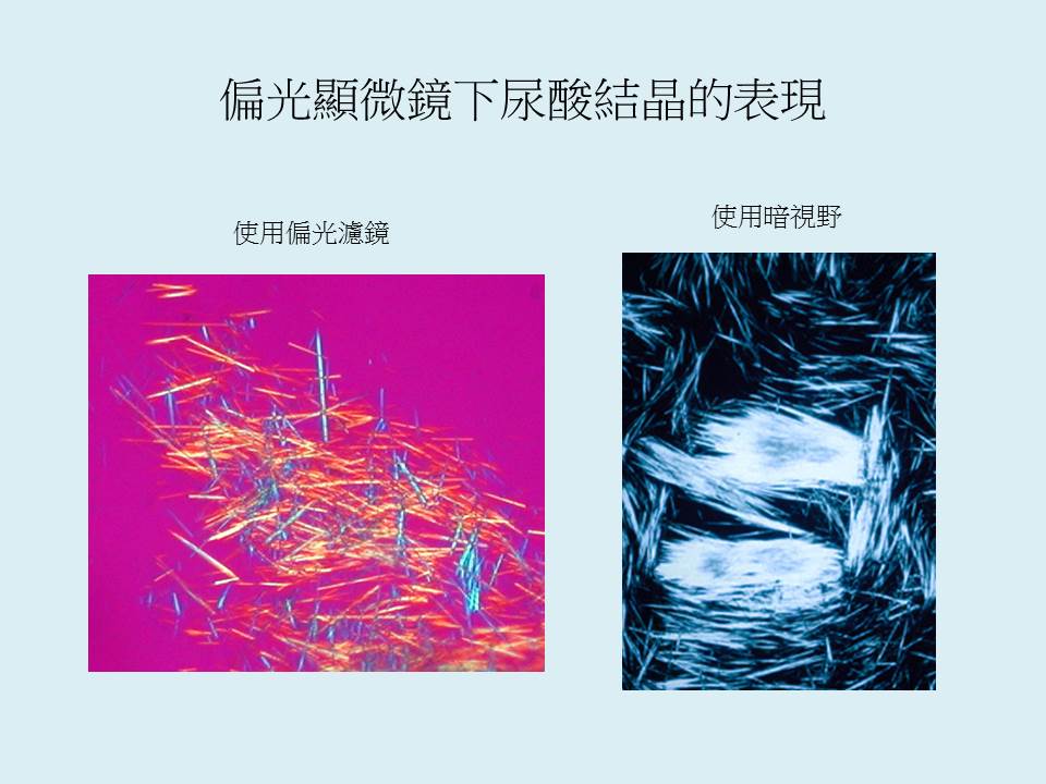 偏光顯微鏡於痛風診斷的重要性